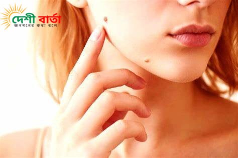 সুতা বা চুল পেঁচিয়ে আঁচিল ঝরালে কী হয় জানেন